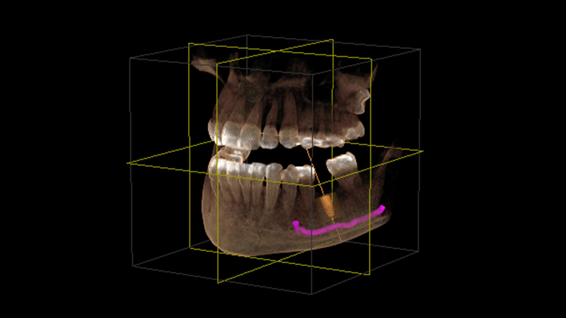 DVT – 3D Implantat Salzburg